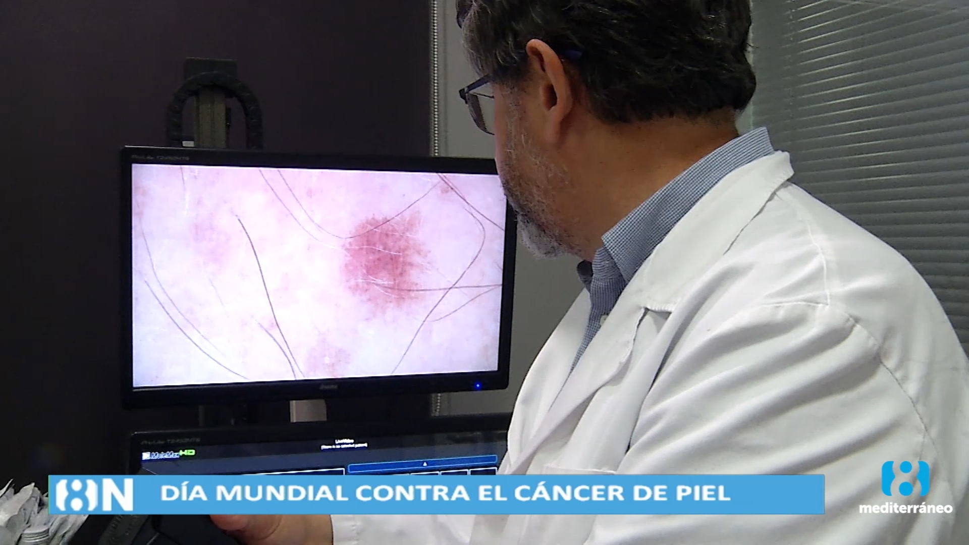 El IVO recuerda que la prevención es clave en la lucha contra el cáncer de piel